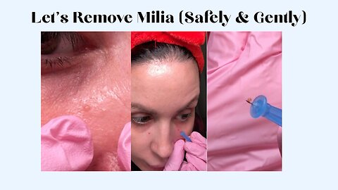 Let’s Remove Milia (Safely & Gently)