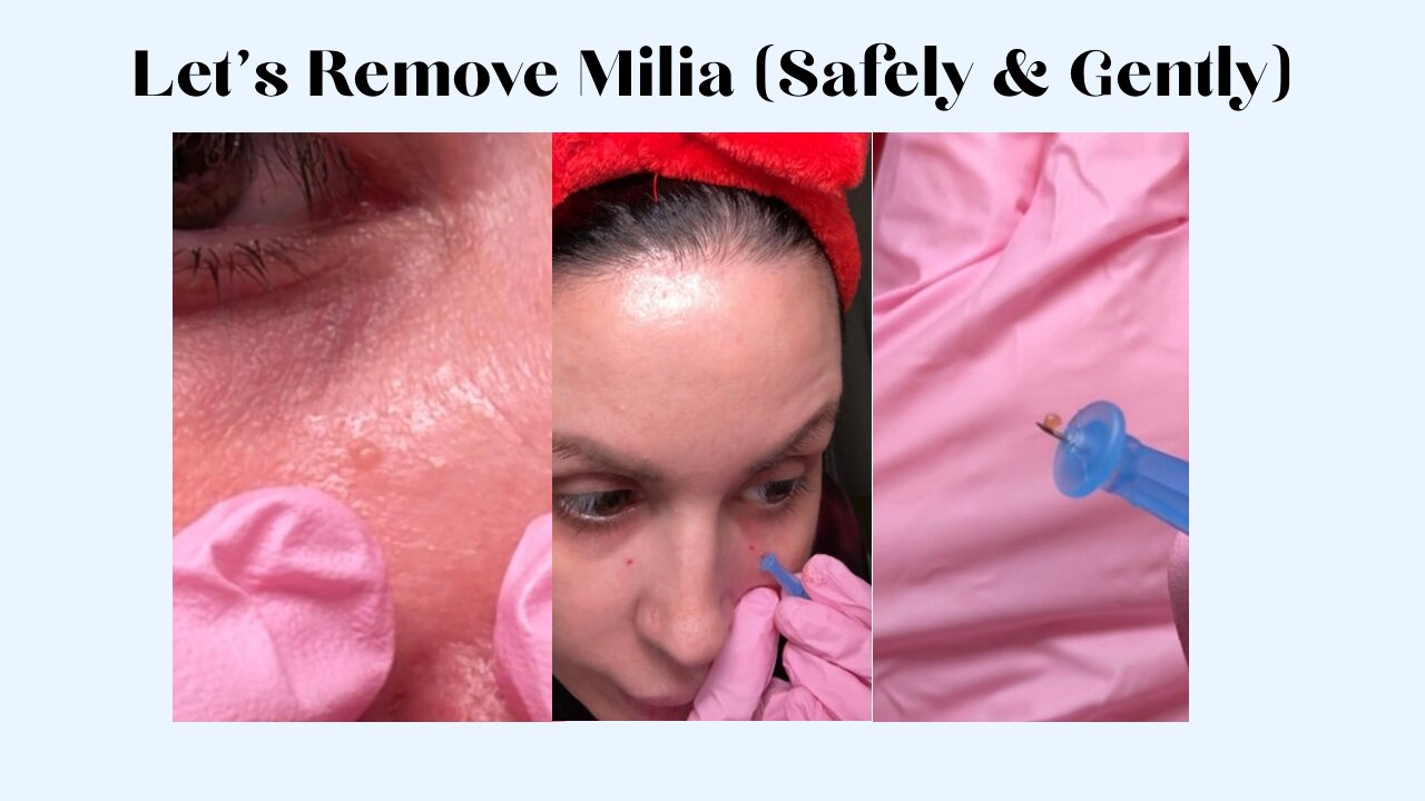 Let’s Remove Milia (Safely & Gently)