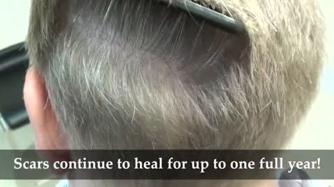 Dr. Brett Bolton | Undetectable Hair Restoration Scar