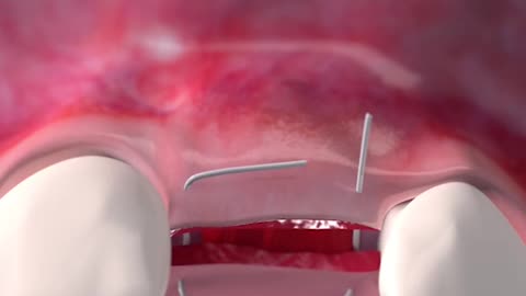 Soft Tissue Augmentation 3D Animation