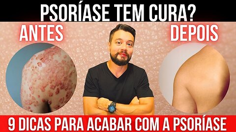 Psoríase e Dieta Carnívora Carnívora: 9 Dicas para acabar com a Psoríase e Dominar Sua Saúde