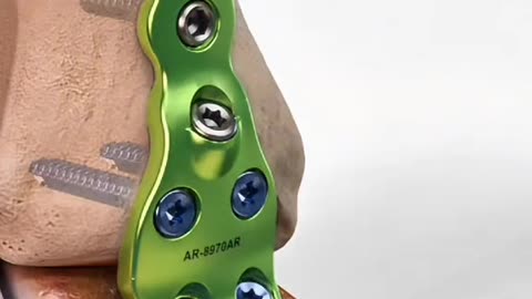 Ankle Fusion Surgery Procedure, Recovery & Benefits Explained