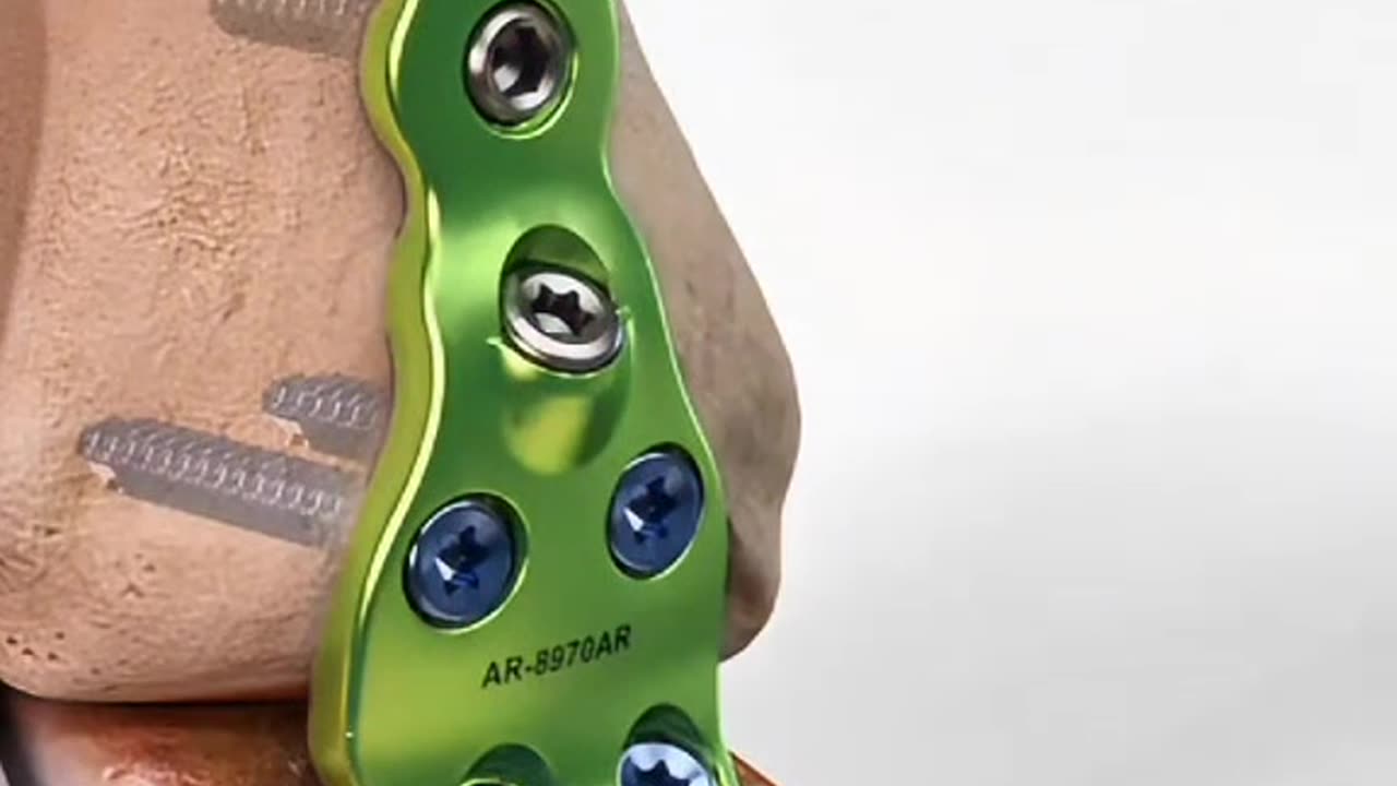 Ankle Fusion Surgery Procedure, Recovery & Benefits Explained