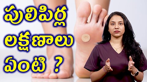 పులిపిర్లు, మొలలు పెండ్లలు లక్షణాలు ఏంటి? What are the Signs and Symptoms of Warts? | హోమియోపతి