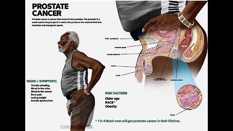 BLACK-NEGROE Men have A 70% HIGHER probability Of developing PROSTATE CANCER during their lives…“For this corruptible must put on incorruption, and this mortal must put on immortality.” 🕎Romans 7:1-25 “the body of this death?”