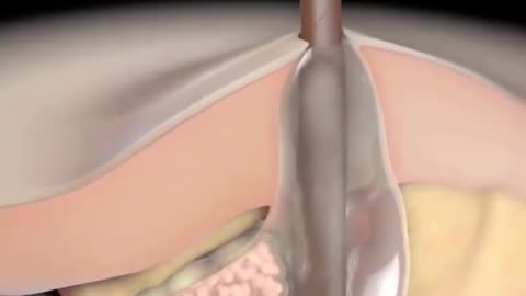 How Acne Develops Different Types Of Acne 3D Animation