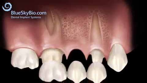 Dental Implants Cambridge: Secure Your Smile