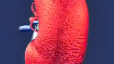 Kidney Transplant Surgery – Life-Saving Organ Transplant Procedure Is Done.