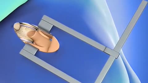 Mitral Valve Repair Surgery Life-Saving Heart Procedure Explained