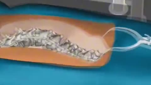 Scoliosis Surgery 3D Animation