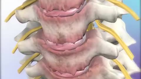 Cervical Spondylosis: Understand Symptoms, Causes, and Effective Treatments