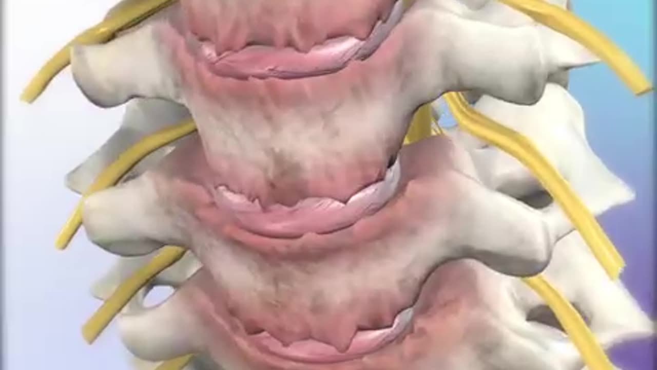 Cervical Spondylosis: Understand Symptoms, Causes, and Effective Treatments