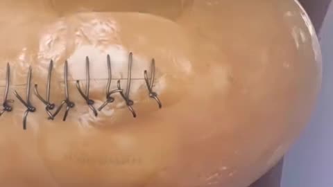 Enlarged Prostate Gland Treatment (3D Animation)