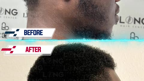 Afro Hair Transplant at Long Hair Center!