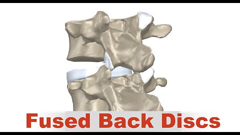 Fused Back Discs Spinal Discs Dr Joel Wallach