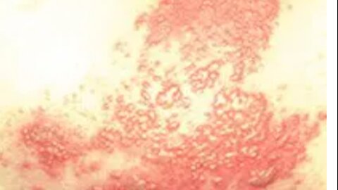 Citrus Synergy: Nourishing the Body Through Shingles