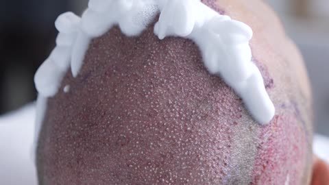 It’s so important to take care of yourself after a hair transplant!