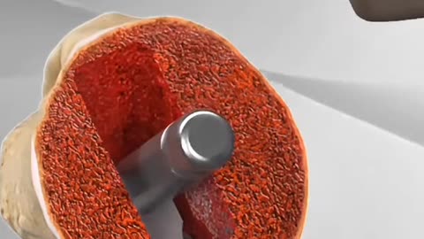 Shoulder Joint Replacement Surgery - Complete Procedure Explained