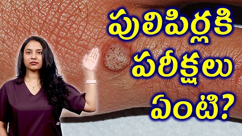 పులిపిర్లు, మొలలు పెండ్లలు కి పరీక్షలు ఏంటి? Tests and Investigations for Warts Treatment హోమియోపతి