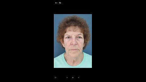 Facelift-Before and After