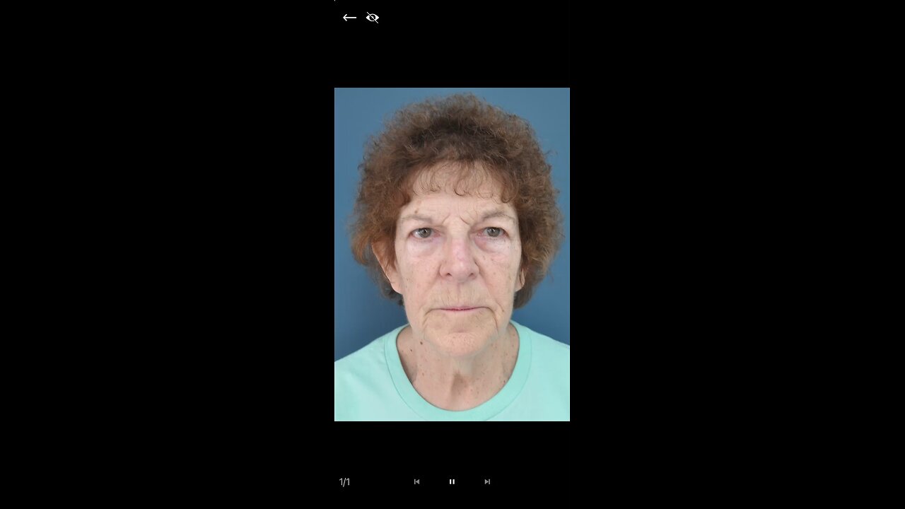 Facelift-Before and After
