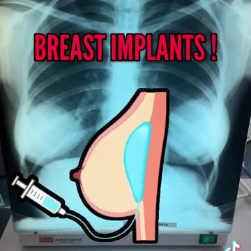 25 year old Breast implants! Whoa 😳😱