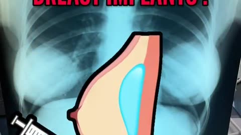 25 year old Breast implants! Whoa 😳😱