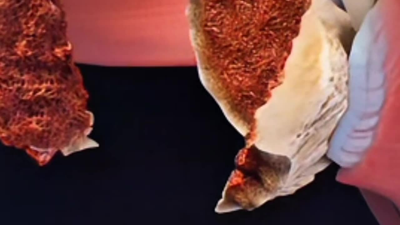 Proximal Humeral Plating Surgery Explained in 60 Seconds