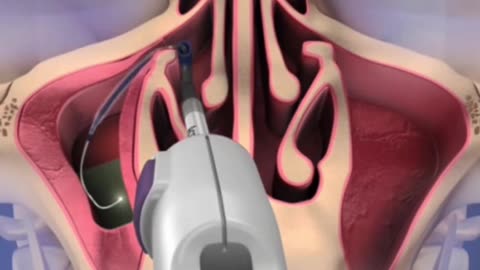 Do You Know Why Balloon Sinupalsty Is Performed (3D Animation)