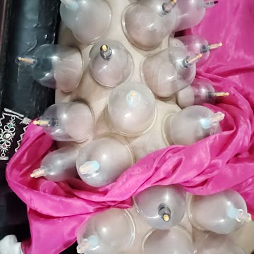 Sciatica Pain Treatment by Cupping Therapy | Effective & Natural Pain Relief