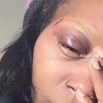 21 showing her black eye after Droski beat her up
