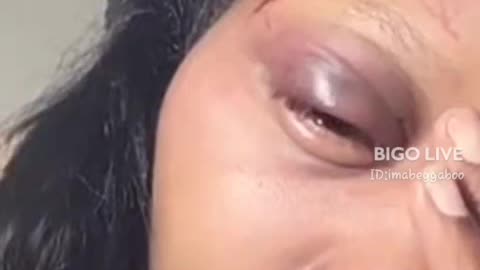 21 showing her black eye after Droski beat her up