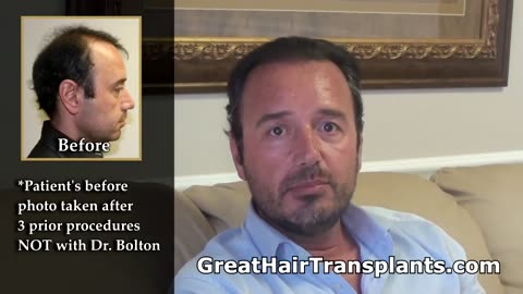 Dr. Brett Bolton Corrects Bad Hair Transplant Results from Other Doctors