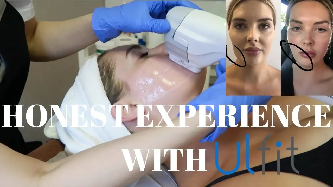 I GOT A FACE LIFT! | HONEST ULFIT EXPERIENCE