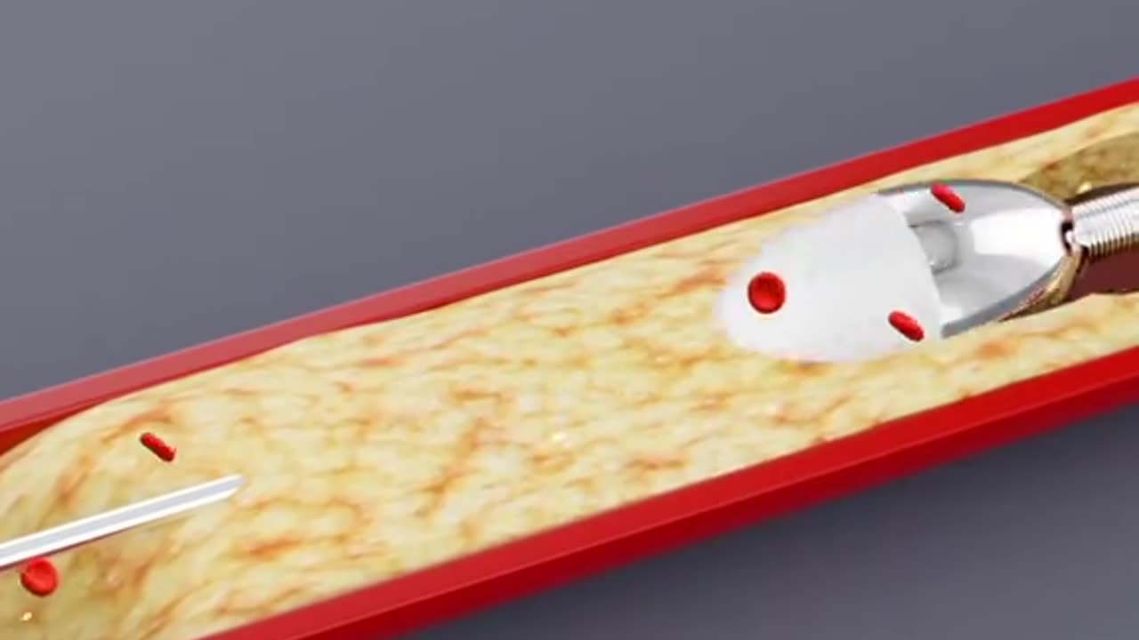 How Rotational Atherectomy is Performed (3D Animation)