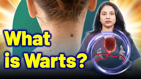 What is Warts, Flat , Plantar ,Papilloma ? | Treatment and Cure | Homeopathy, Medicine & Surgery