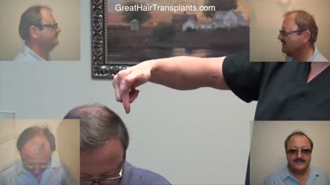 Dr. Brett Bolton Patient Peter – MaxHarvest™ Hair Transplant