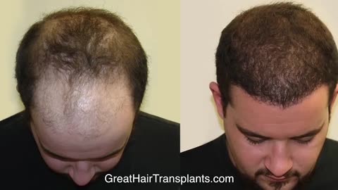 Transformative MaxHarvest™ Hair Transplant by Dr. Brett Bolton