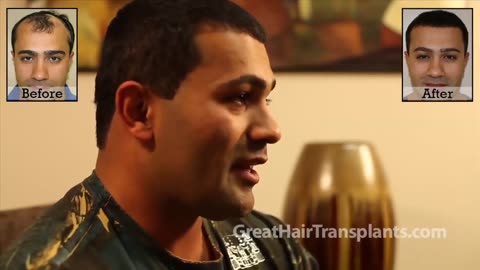 Burn Patient Restores Hair with Dr. Brett Bolton’s MaxHarvest™ Procedure