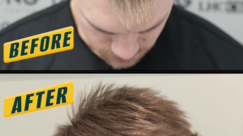 A hair transplant can be performed with good results, leaving the donor area unharmed.