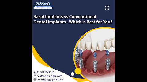 Basal Implant vs Conventional Implant Key Differences & Advantages Dr. Garg’s Dental Center
