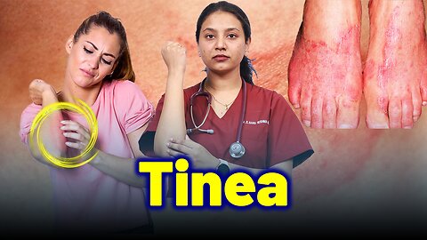 Permanent Solution for Tinea,Dermatophytosis, Ringworm.| Treatment Cure Relief Medicine |