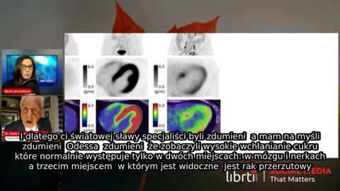 Wstrząsające odkrycie w skanach PET/CT serc osób zaszczepionych przeciwko Covid