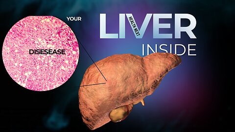 Fatty Liver Symptoms | How to prevent l of Fatty Liver Disease | Non Alcoholic Fatty Liver Disease