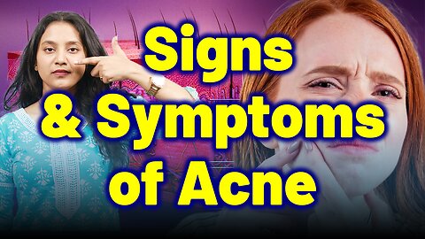 Signs and symptoms of Acne, Pimple , Blackheads .| Treatment Cure Relief Medicine Homeopathy,