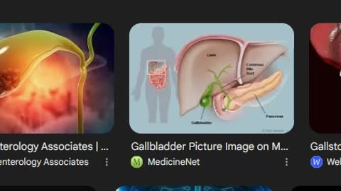 GALLBLADDER PAIN REMEDY! INSIDE TIPS ON HOW TO FIX IT