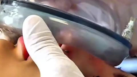 Cancerous Colon Removal Surgery (Colectomy)