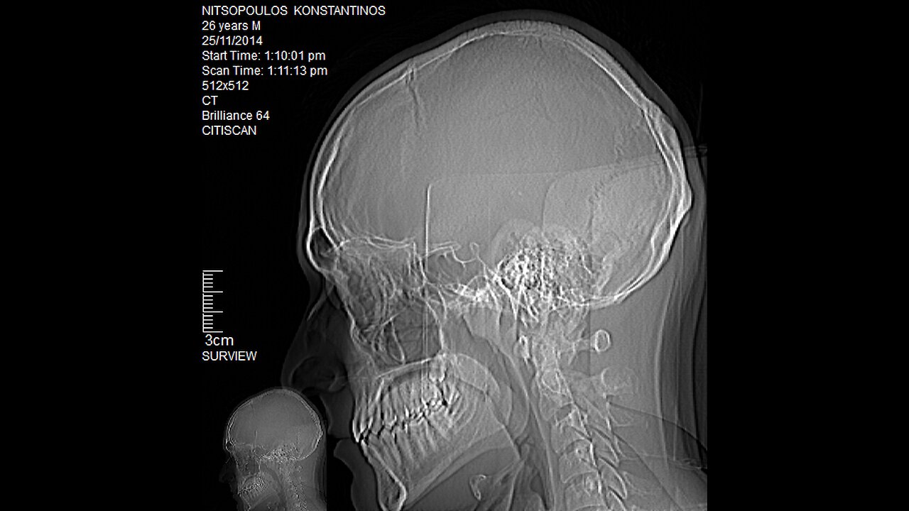 CT SCAN (NOV 2014), Brilliance 64 (Philips), 512p 20fps