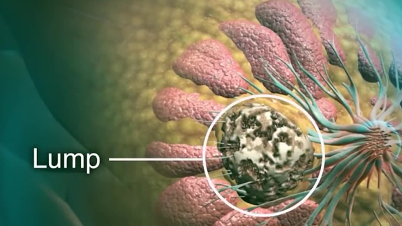 Mammography Procedure 3d Animation (Mammogram) How Mammography Is Performed