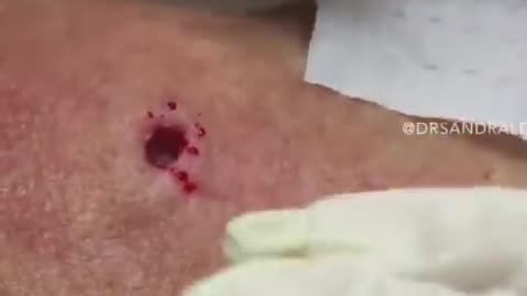 85 Year Old Blackhead Dr Pimple Popper Most Popular Pop of ALL TIME
